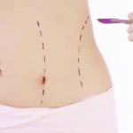 Abdominoplastia