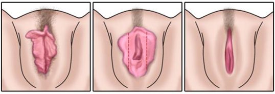 ninfoplastia-cirurgia-intima