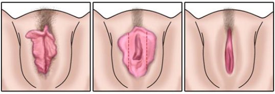 ninfoplastia-cirurgia-intima