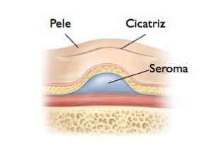 seroma-cirurgia-plastica