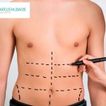 Abdominoplastia masculina