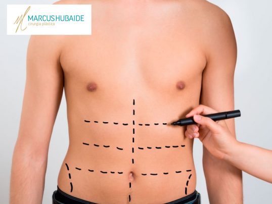 Abdominoplastia masculina