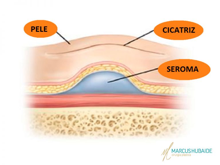Saiba tudo sobre seroma encapsulado | Dr. Marcus Hubaide - Cirurgia ...