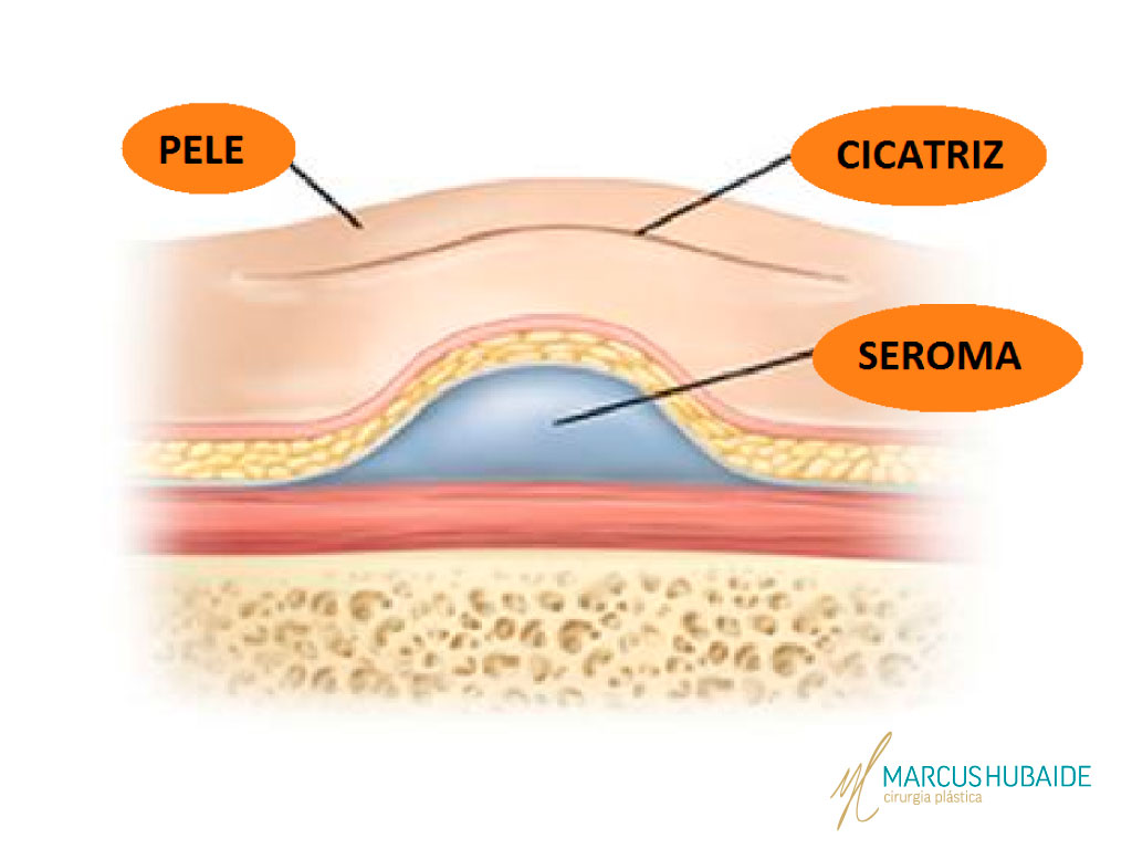 Após cirurgia, Ferreira para por no mínimo mais dois meses - 13/05