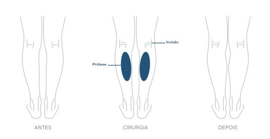 tipos-de-protese-