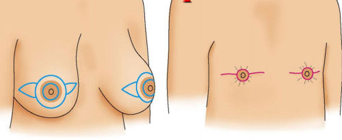 Resultado de imagen para mastectomia masculina